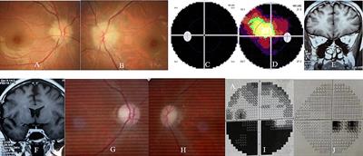 Case report: Satralizumab as an adjunctive therapy for AQP-4 antibody and MOG antibody dual-negative optic neuritis in a third-trimester pregnancy case